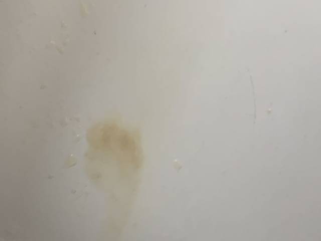 检查有一个宫颈息肉 宫腔内也有积液,有谁知道