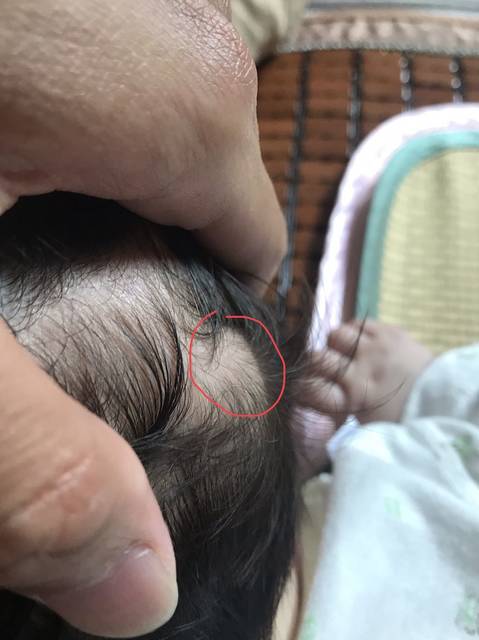 四个月宝宝后脑勺长了个鼓包,有宝妈们知道去哪个医院