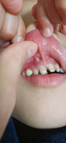男宝六周岁,换牙期牙龈上面长出牙齿了,怎么办