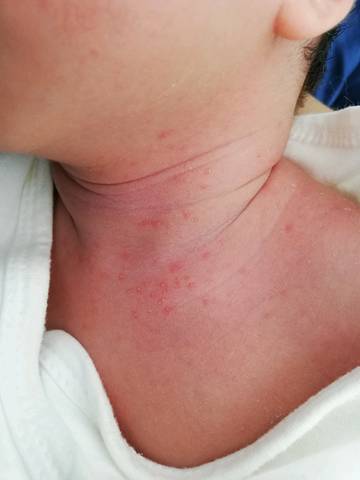 10天的女宝宝,脖子上起了很多小疙瘩,是怎么回事?