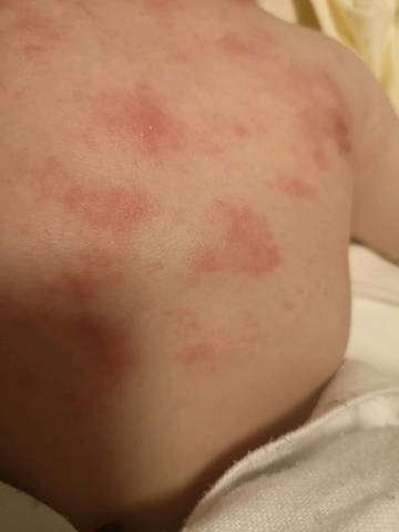快五个月的宝宝,前胸和后背长了好多红疹子,开始还只有一点,今天发现