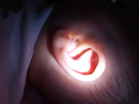 宝宝二个月,前段时间耳朵有黄色的黄痂,每天都会清理