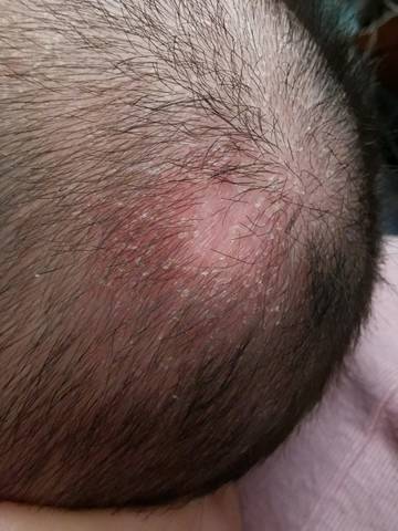 两个多月宝宝点宝宝头顶又头皮屑,而且今天发现还秃了