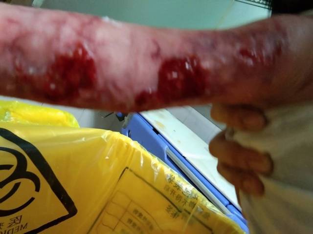 宝宝烫伤伤口怎么愈合快,有图慎入