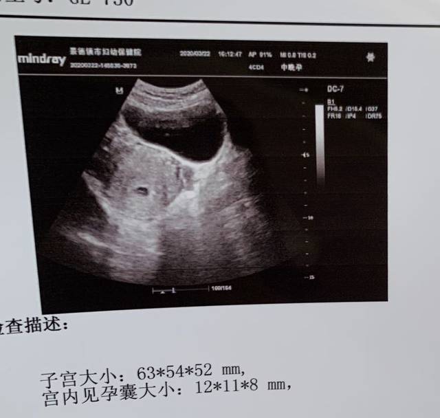 今天怀孕37天第一次产检_你们说的孕囊茄子型是多久照