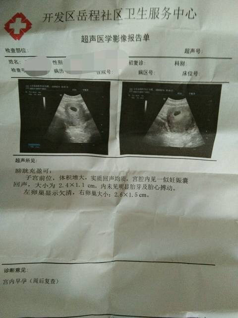 孕囊看着像椭圆形,50天,宝妈看孕囊是男还是女呢?