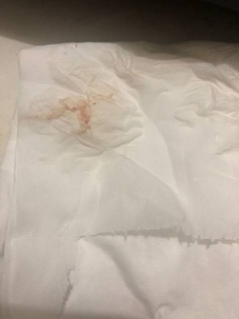 囊胚移植第九第十天一直有褐色和粉褐色分泌物!