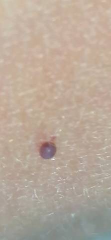 宝宝左胸外长了一颗这个的小血泡,有点紫,又像虫子,求解!