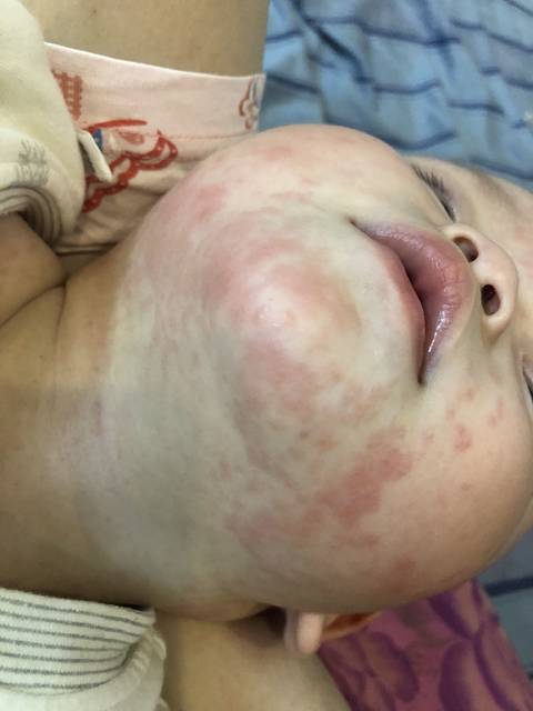 宝宝第一次发烧,退烧后突然长了这些,是幼儿急疹吗