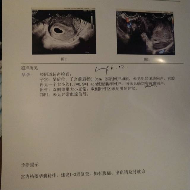孕6周 今天做阴超检查的_宝宝