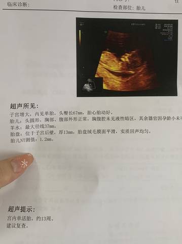 想请大家帮忙看看nt是男宝还是女宝
