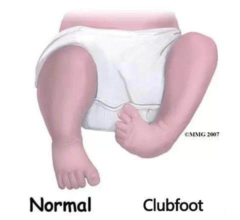 穿错鞋毁一生~宝宝小脚丫,选鞋大学问