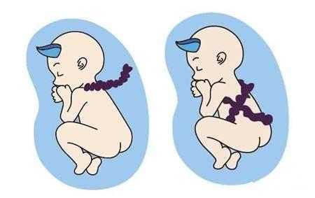 6个月胎儿脐带扭转导致胎死腹中,警惕孕期脐带