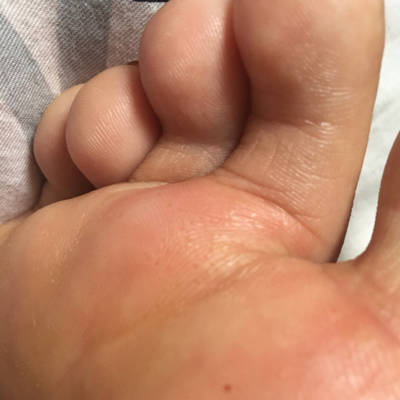 怀孕后手脚皮肤有针眼大小的透明小水泡没在皮肤表面是怎麼回事,很痒