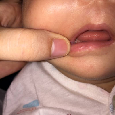 宝宝一个多月,牙龈上有这种白色的小泡,是怎麼回事呢,怎麼治疗