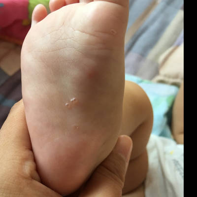 宝宝汗疱疹图片脚上图片
