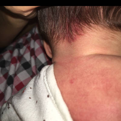 婴儿颈部红斑图片大全图片