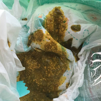 宝宝拉这种大便是消化不良吗,还是怎麼啦