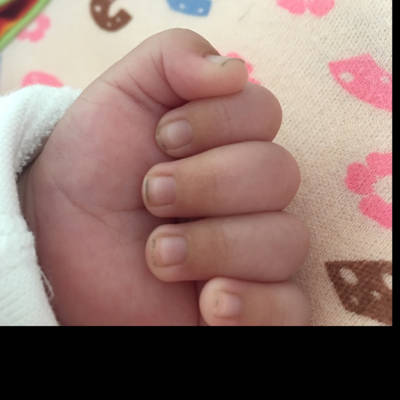 宝宝50天了手指尖发黄是什麼原因?