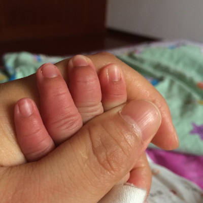 宝宝出生20天发现双手指甲根部发黑怎麼回事啊?