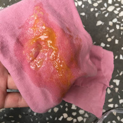 今天宝宝拉的便便跟鸡蛋清似的怎麼回事,早上拉的还