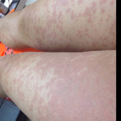 怀孕33周了,最近得荨麻疹了,太难受了,奇痒无比,尤其是晚上,医生开的