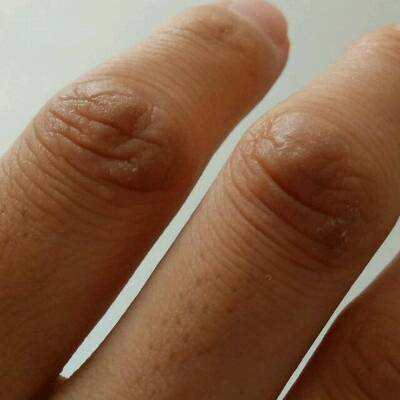 婴儿手指第一节皮肤暗图片
