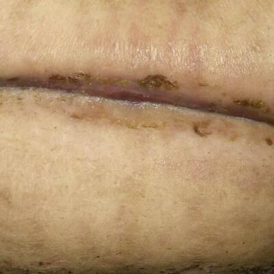 这刀疤怎样能恢复的快,超级难看,或者哺乳期怎样能减重有图慎入