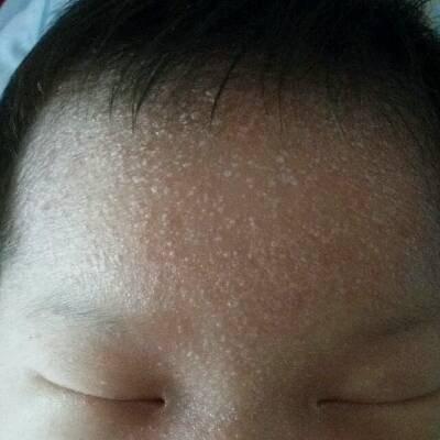 新生儿脸上透明水泡图图片