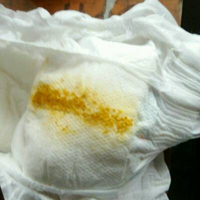 44天宝宝拉屎是水,老打屁也会顺带打出屎,而且都很希,像水一样,怎麼办