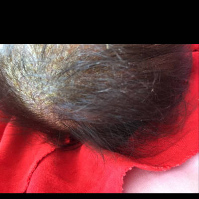 武汉             最佳回答          赶快把头发剪掉,看着像黄水疮