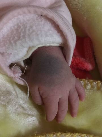 宝宝手背上有胎记