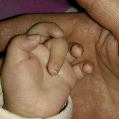 宝妈们,我家宝宝三个月了手指是这种形状的,中指总是抬不起来,而且大