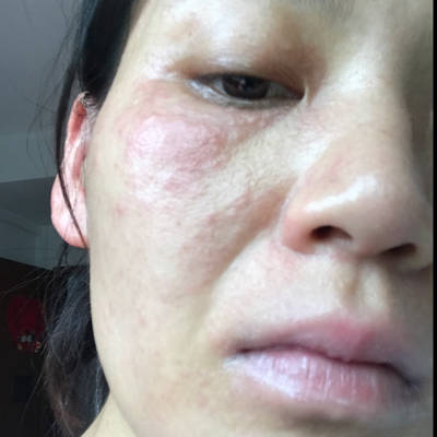 推荐回答 树友kw3iq7yl:昨天抽血化验了,说不是过敏也没有细菌感染,给