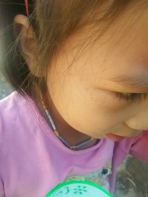 求助_我女儿的脸上(有点像斑)黑点点有人说是晒斑越长大_宝宝树