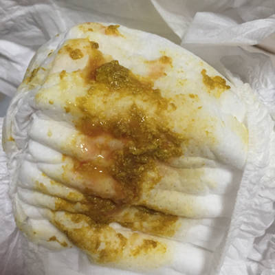 急急急!6个月的宝宝便血是怎么回事?今晚已经拉了三次了!