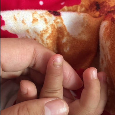 宝宝最近指甲从根部脱离了,是不是灰指甲啊?怎麼治呀?