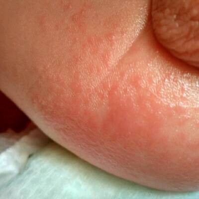 女宝宝尿布疹初期图片图片