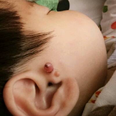 耳朵长脂肪瘤图片大全图片