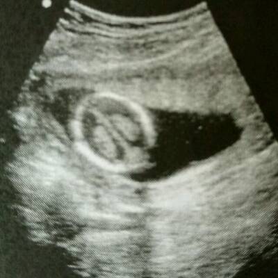 15周胎儿男孩清晰大图图片