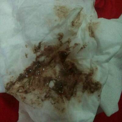 第三天喝母乳两个奶头都吸破了,还出血了,她吐奶的时候吐出来是褐色的