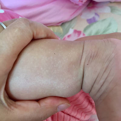 宝宝腿上有一小块白斑图片