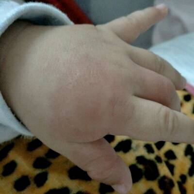 婴儿手指红肿硬图片图片