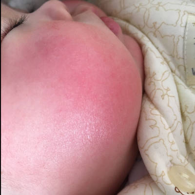 宝宝冬天脸一直特别红,感觉皮肤很乾怎麼办