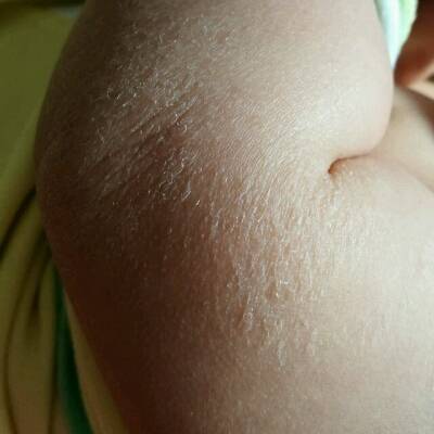 婴儿环状湿疹图片