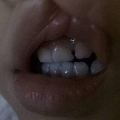 孩子两周多点,门牙根部发黄有凹槽,牙缝有洞,是什麼原因?