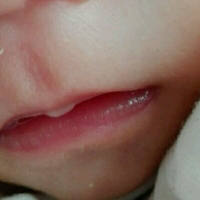 婴幼儿嘴角疱疹图片图片
