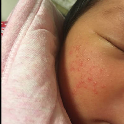 新生儿湿疹 面部图片