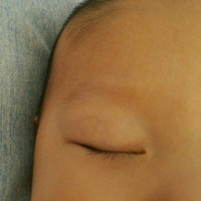 3个月宝宝眼皮红图片图片