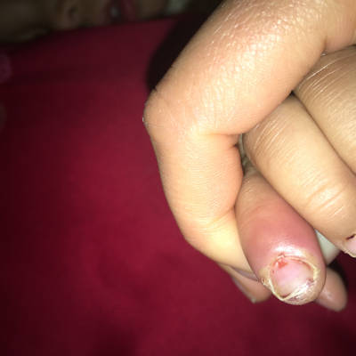 宝宝手指感染化脓图片图片
